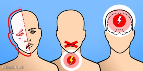 Đột quỵ não: Nhận biết sớm, cấp cứu kịp thời
