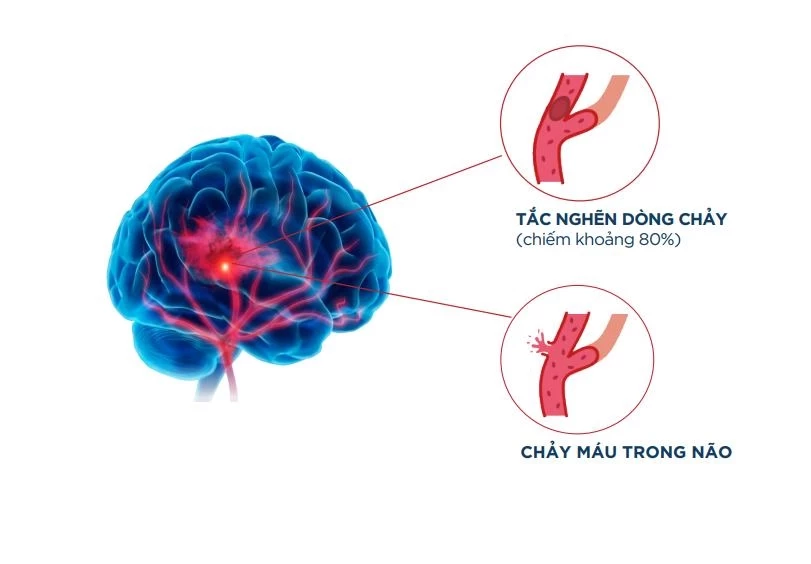 Đột quỵ não: Nhận biết sớm, cấp cứu kịp thời