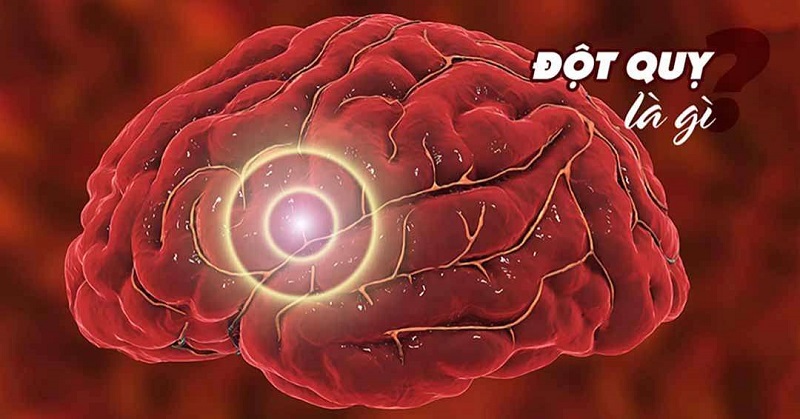 Đột quỵ ở người trẻ: Nguyên nhân, dấu hiệu và cách phòng ngừa