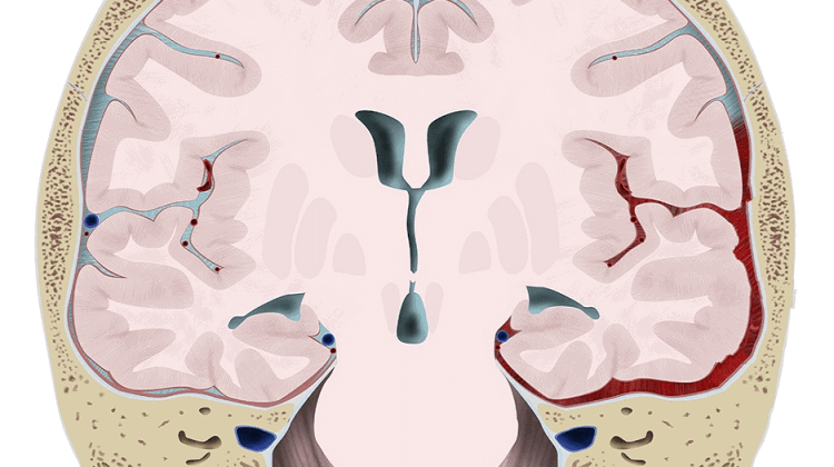 Chấn Thương Sọ Não Là Gì? Triệu Chứng và Phương Pháp Điều Trị Hiệu Quả 2 Chấn Thương Sọ Não Là Gì? Triệu Chứng và Phương Pháp Điều Trị Hiệu Quả