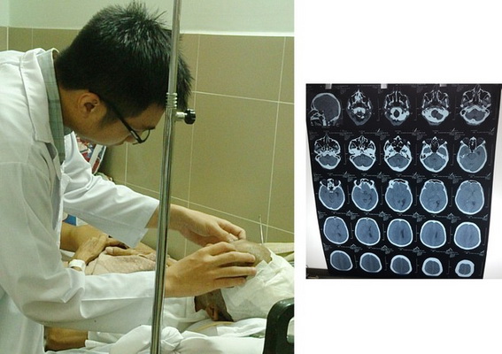 Điều Trị và Hồi Sức Chấn Thương Sọ Não Nặng Hiệu Quả