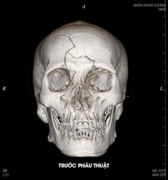 Hướng dẫn phục hồi chức năng sau tai nạn chấn thương sọ não